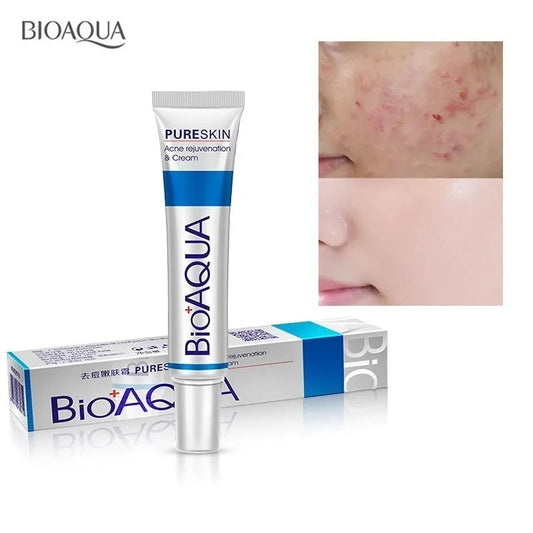 Bioaqua 30g Acne Treatment Blackhead Remova Anti Acne Cream Oil Control Shrink Pores Acne Scar Remove Face Care Whitening