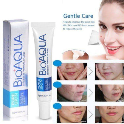 Bioaqua 30g Acne Treatment Blackhead Remova Anti Acne Cream Oil Control Shrink Pores Acne Scar Remove Face Care Whitening